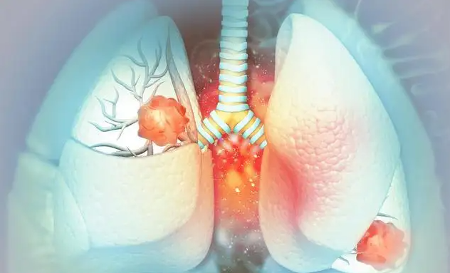 肺癌|6mm肺结节3个月就消散了!只因他生活中经常做“这件事”