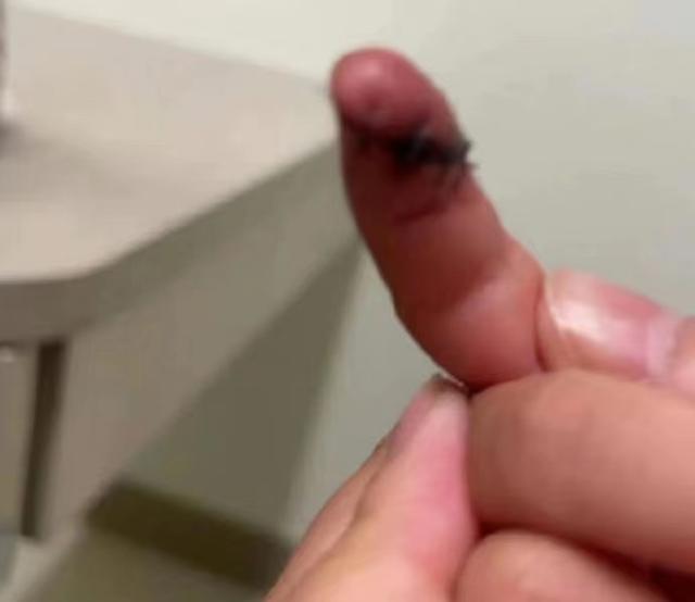 郑星源|张恒起诉郑爽虐待女儿，爆出孩子缝针伤口，伤口有6厘米