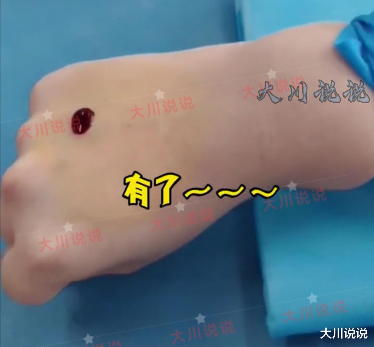 医学生|女医学生练习扎针,好奇没有血,网友看过直言:能不能去外国工作