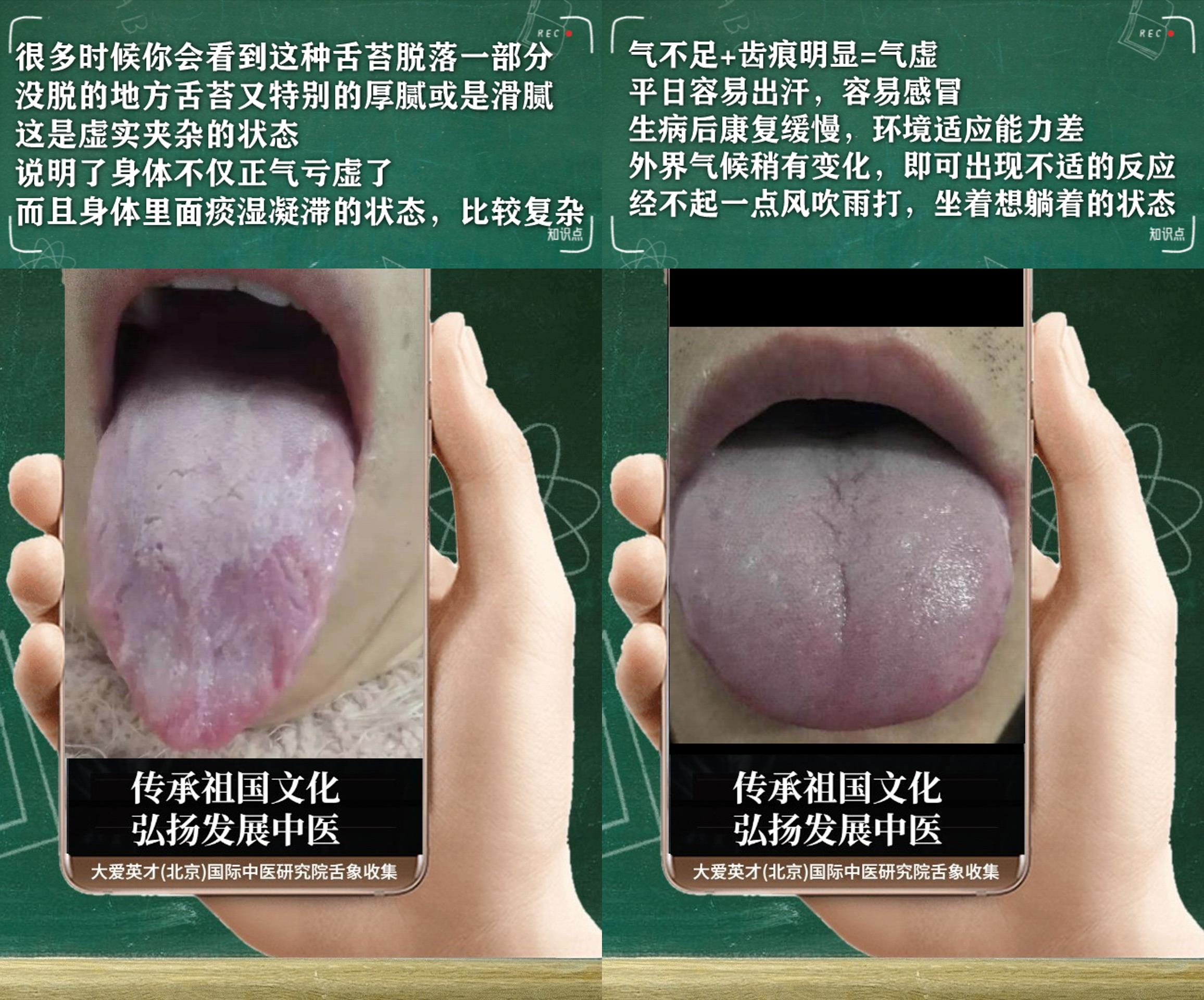 咳嗽|中医分析:易愁苦,手足心热,咳嗽重,吐黏痰,经常复发很绝望