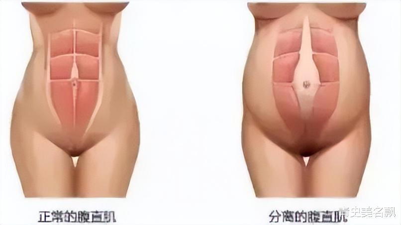 产后恢复|卡戴珊家族最美女人曝产后肚皮松垮难恢复：这才是产后正常的样子