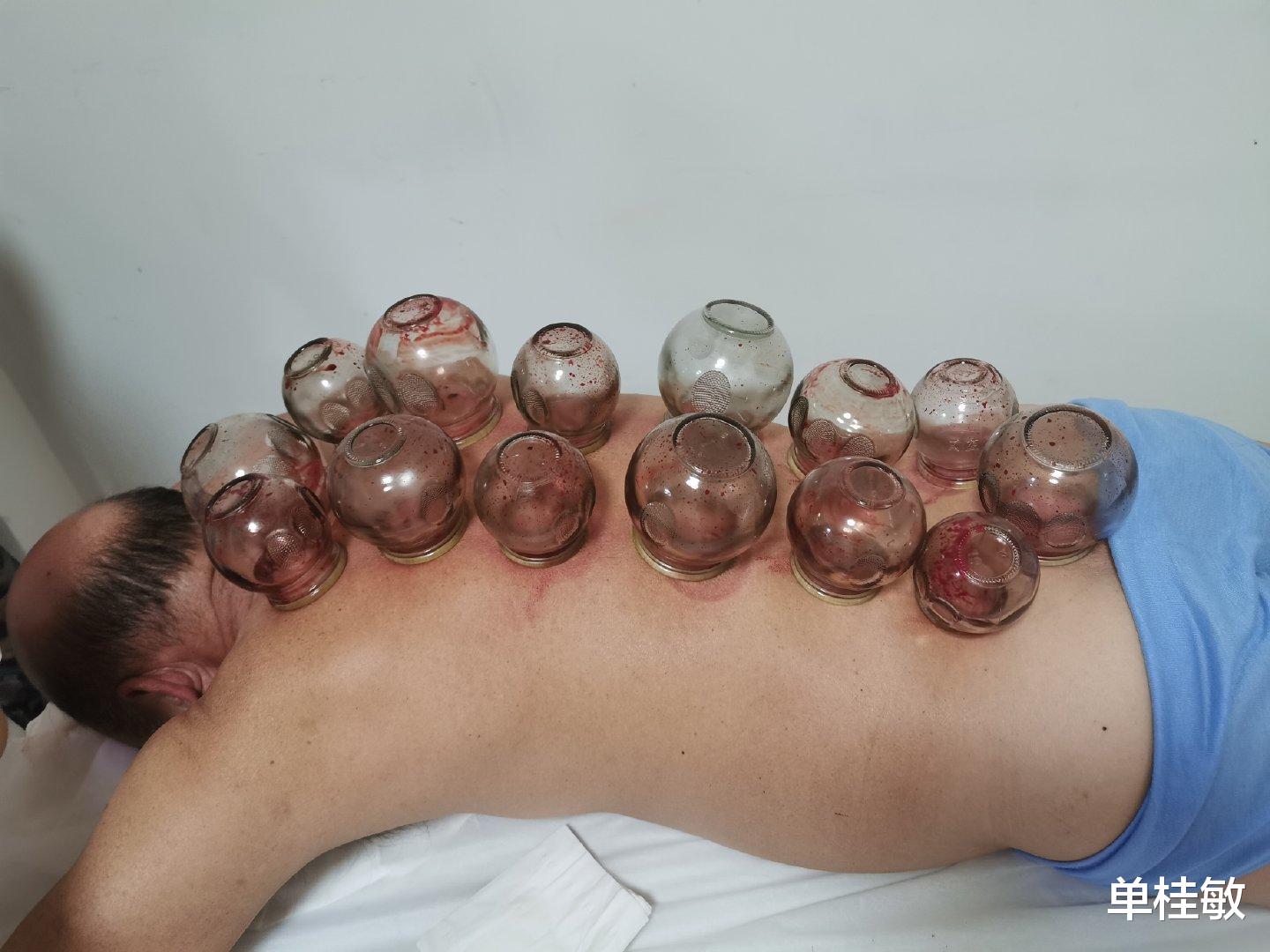 失眠|上火可以拔罐走罐