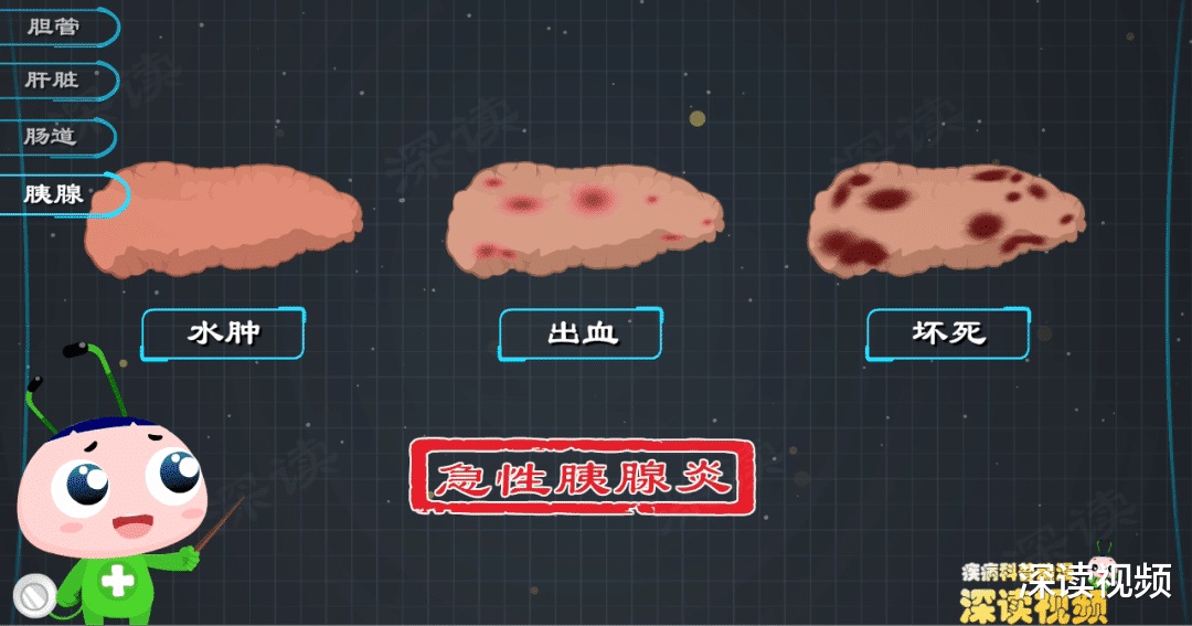 胆管结石|胆管结石是怎么搞坏你的肝，胆，肠，胰的？画得太棒了！