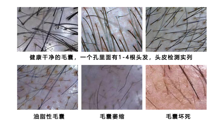 脱发|脱发治疗关键步骤,毛囊检测究竟有什么用?