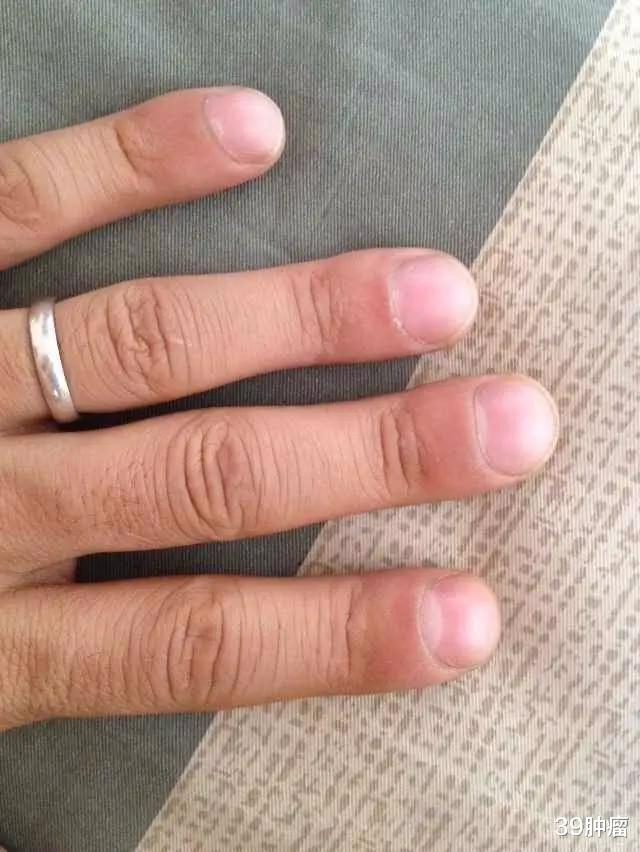 肺癌|出现“杵状指”,是肺癌的信号吗?有这种可能,但没那么简单