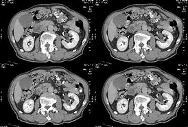 蛋白质|异常体重下降小心胰腺癌,发生重视身体的变化
