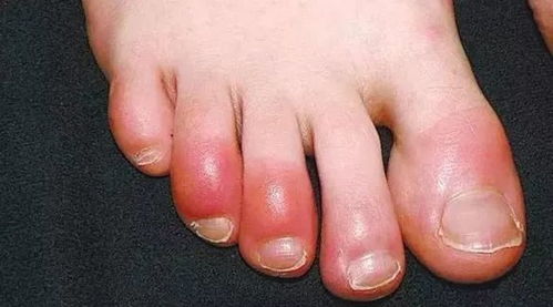 咳嗽|一个治冻疮妙方,暖手脚、防冻疮,温经散寒,让你温暖过冬