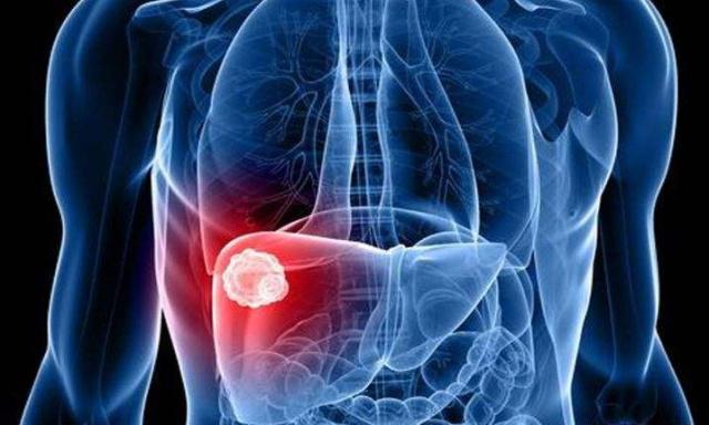 肝脏|肝脏有无硬化,“看双手”可能会知道,这三种情况,占一个就很好