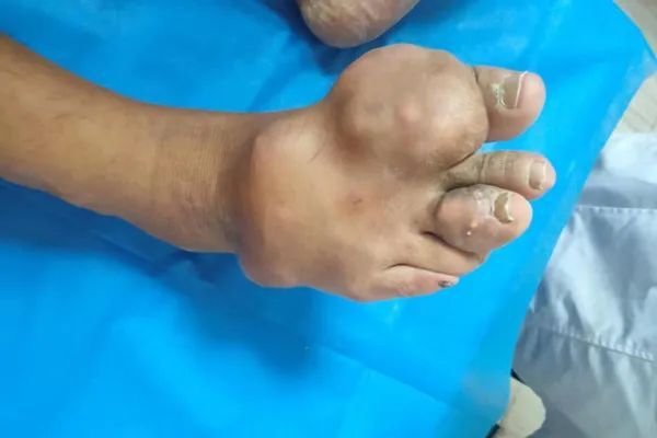 痛风|怎样溶解痛风石？吃药能溶解吗？