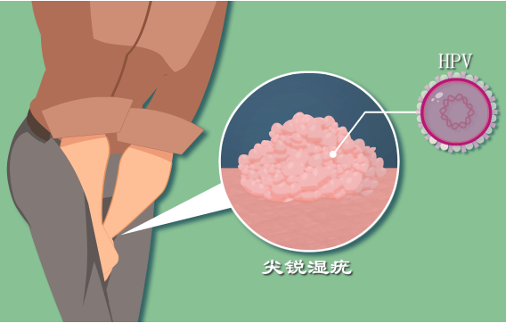 二氧化碳|皮防科普丨选择合适的方法,为你排“疣”解难
