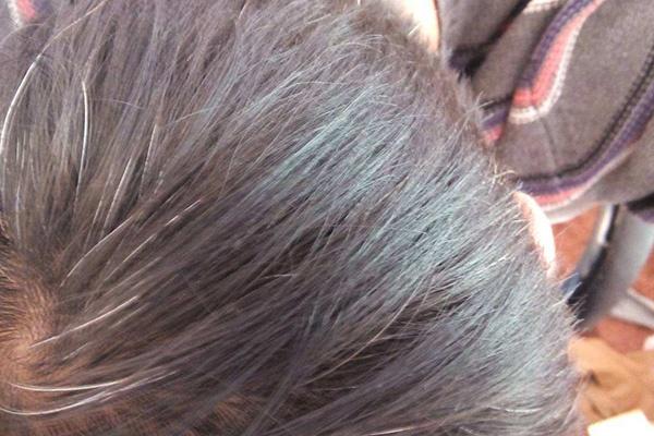 人参|才40来岁，为什么有的人就长白发了？可能是身体这3方面出了问题