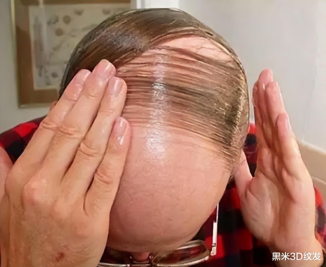 痰濕體質|防止脫發，那些坑人小妙招，禿得更徹底