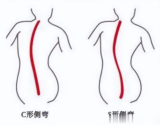 张钧甯|40岁张钧甯冻龄像20，高低肩不美毁身形，做好这3步重塑好身材