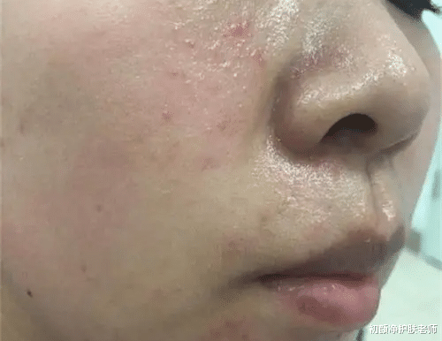 护肤品 如何快速修复敏感肌？千万别走了弯路而不自知！