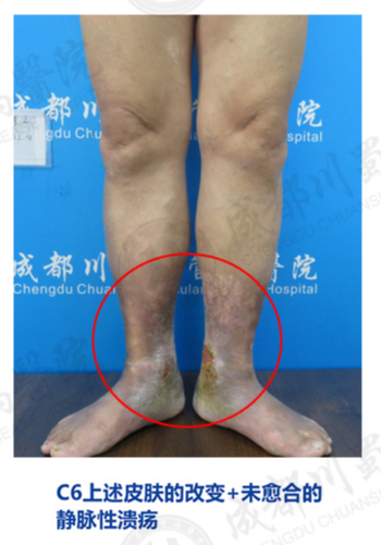 静脉曲张|下肢静脉曲张，要早治！川蜀专家：不要等腿烂了才治，此时久难以根治了！