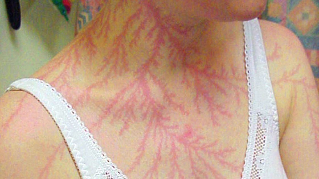 奇闻：国外一半聋半瞎的人被闪电击中，幸存后听力和视力神奇恢复