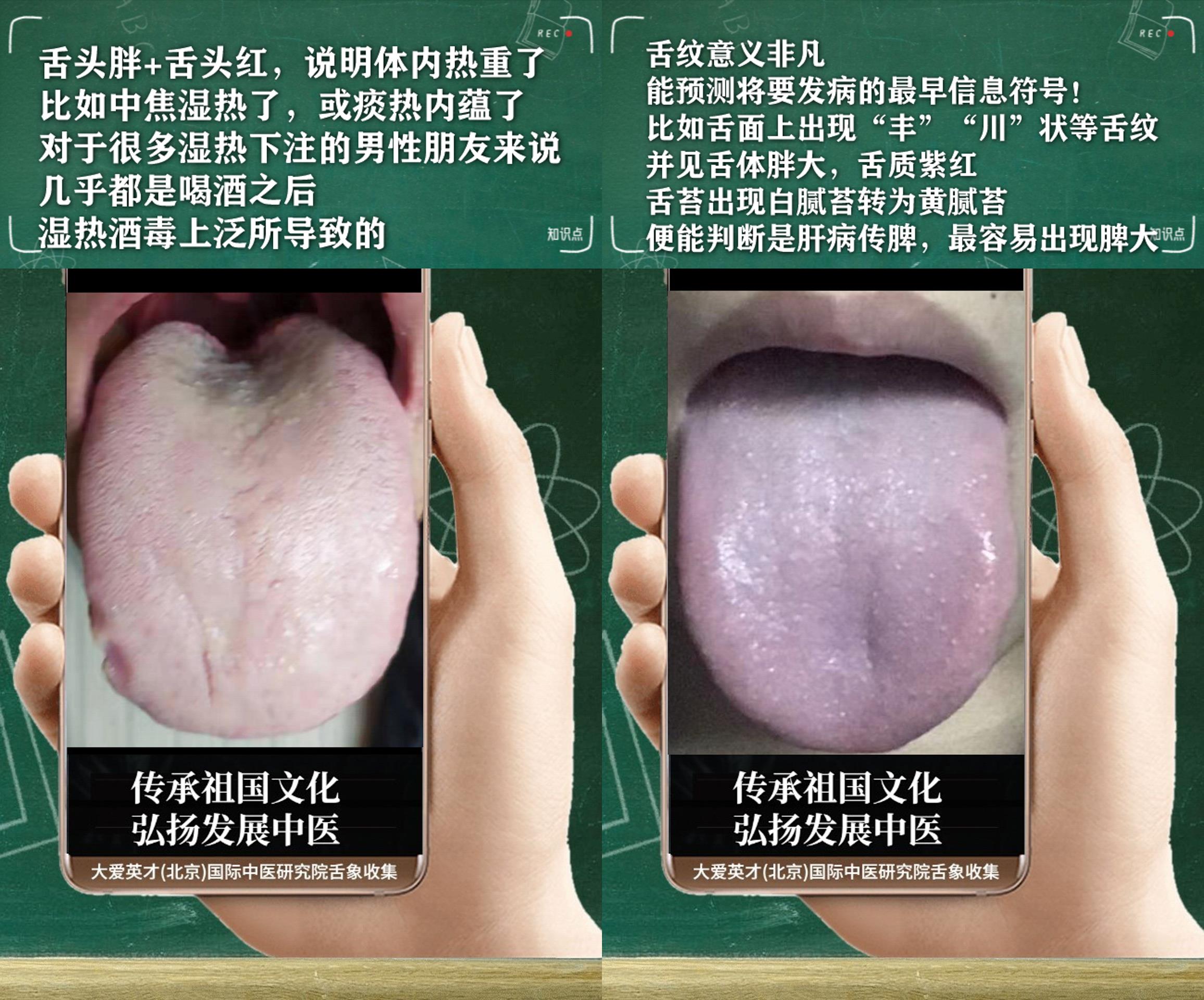 灰指甲|经常出现积食,腹泻,头晕目眩,脾胃失调的舌象讲解