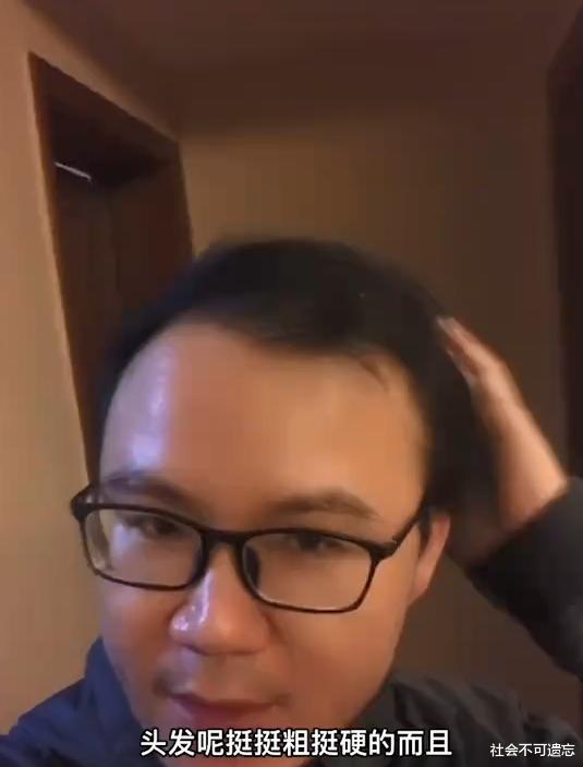 小姐姐 新奇！男子秃顶求医无效，半个月不用洗发水竟长出头发：又粗又硬