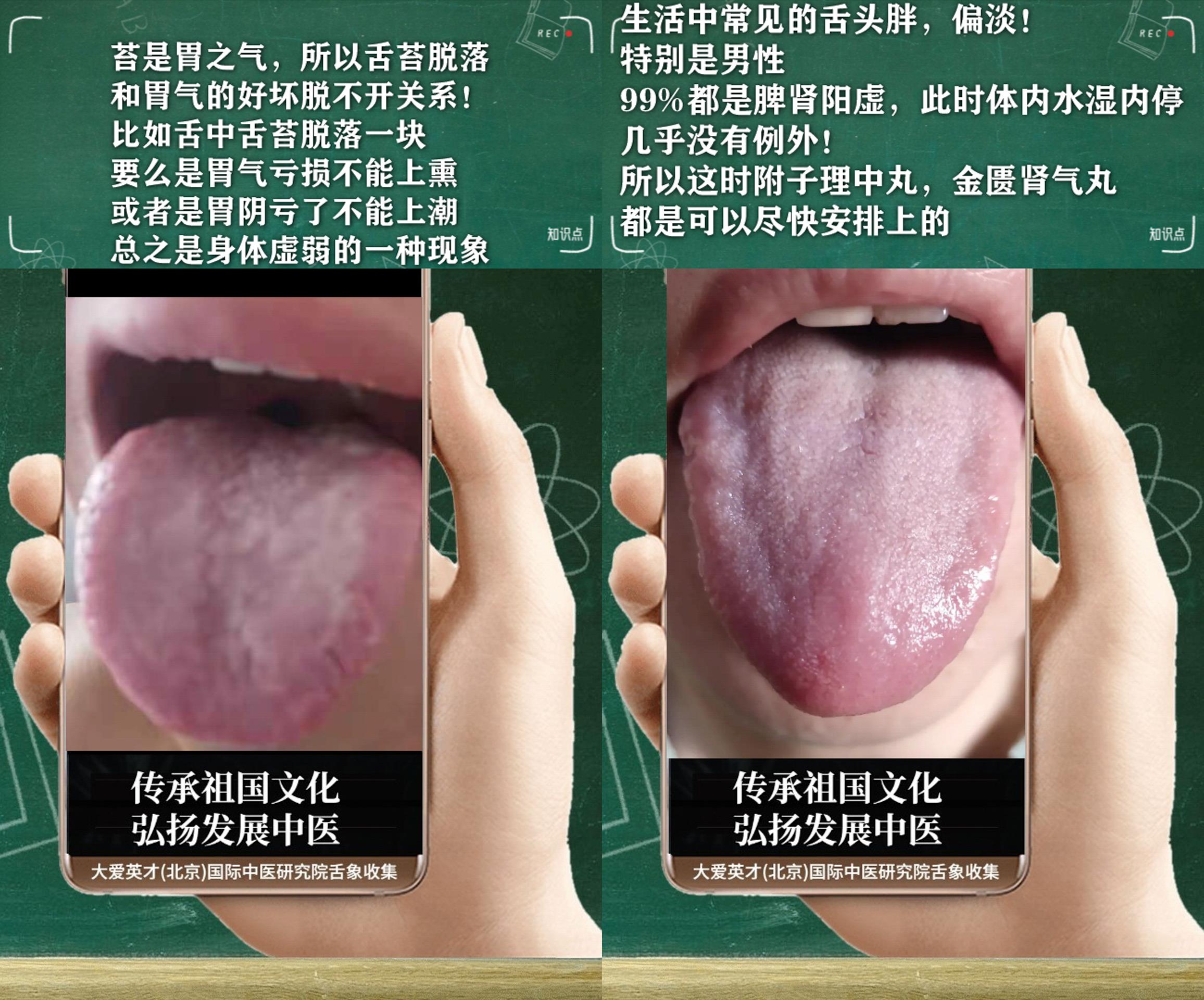 脂肪肝|中医医案：经常咳嗽，伴有大便干结，性功能减退，湿热下注的舌象