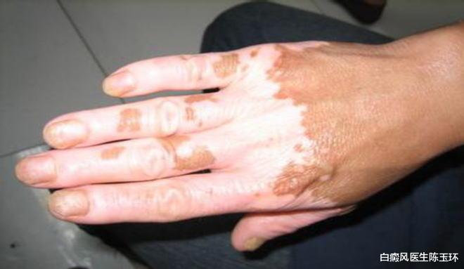 脑梗|白斑反复复发可能是因为只“治标”没“治本”