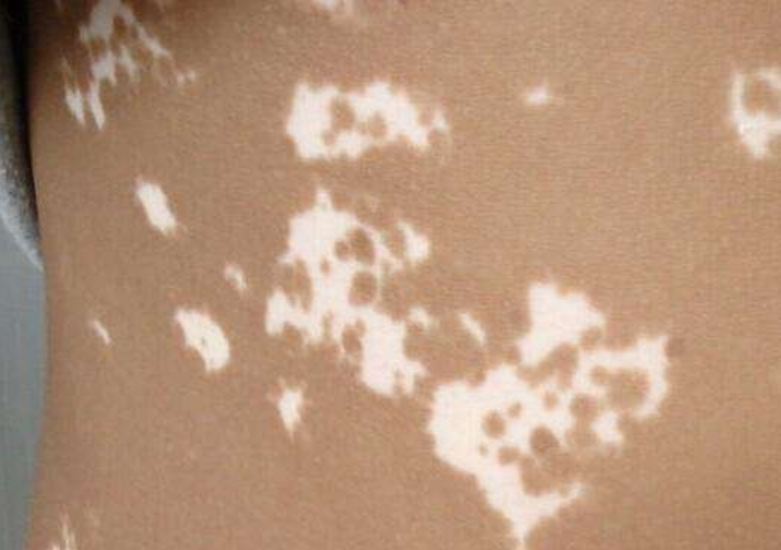 肝脏|28岁小伙白癜风治疗后不长黑点点？来看看怎么回事