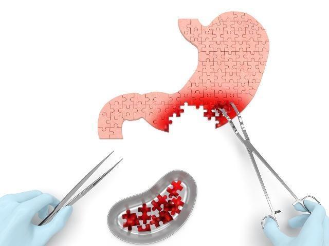 胆固醇|饭后若有这3个“变化”,可能是胃癌早期信号,不妨一看