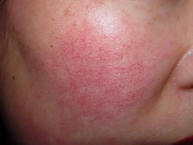 减脂 如何去除脸部红xue丝?牢记以下7点,赶走难缠“红xue丝”!