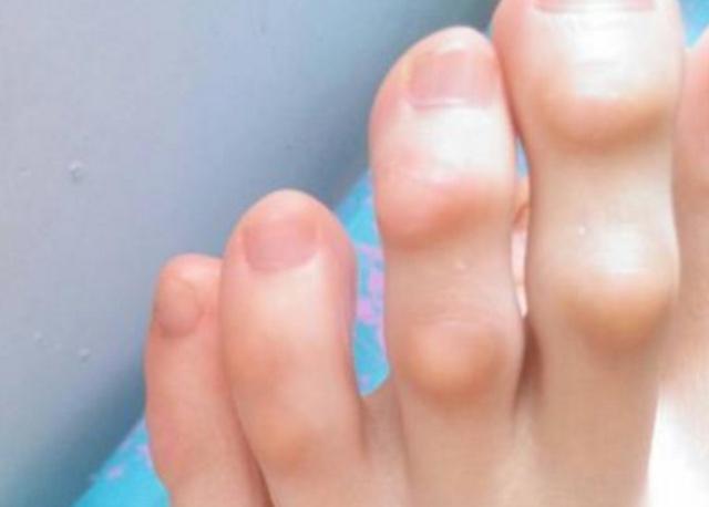 祛湿|若脚上没有这3个“信号”,或许肾脏比较健康,早看早知