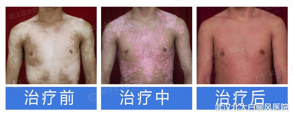 高血脂|让患者享受式治疗白癜风,中医药浴做到了