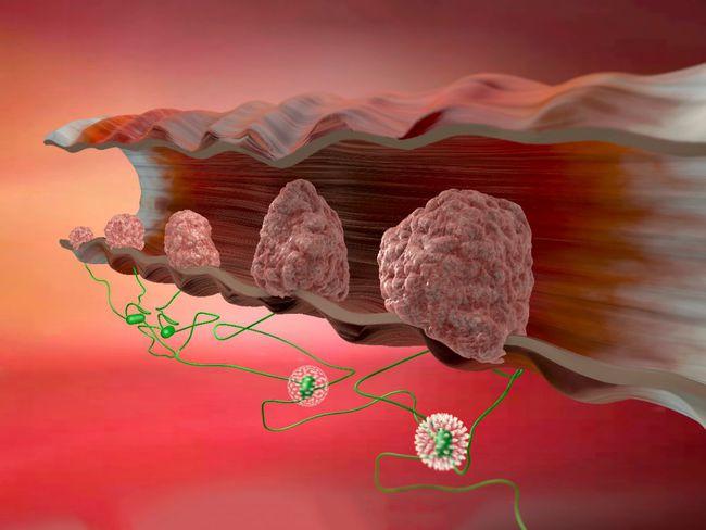 胆固醇|30岁博士查出hpv,提醒:不想宫颈病变 ,2种食物“白送”也别吃