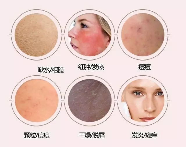 护肤品 脸部过敏怎么快速消除？学会这三招，拯救甩不掉的敏感肌！
