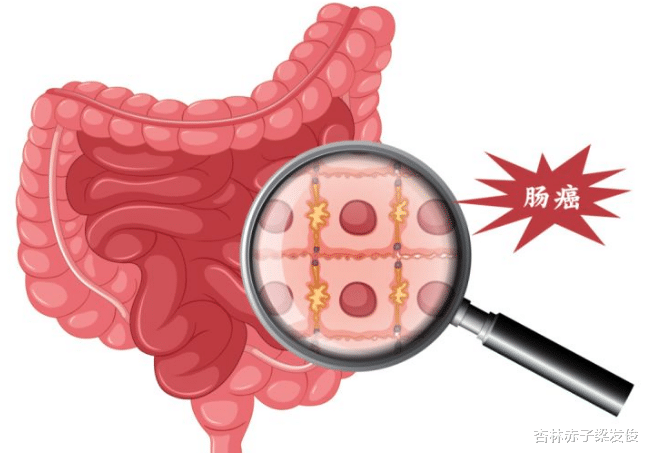 水果|做一次肠镜,能保几年平安?5年还是15年?医生告诉你答案!