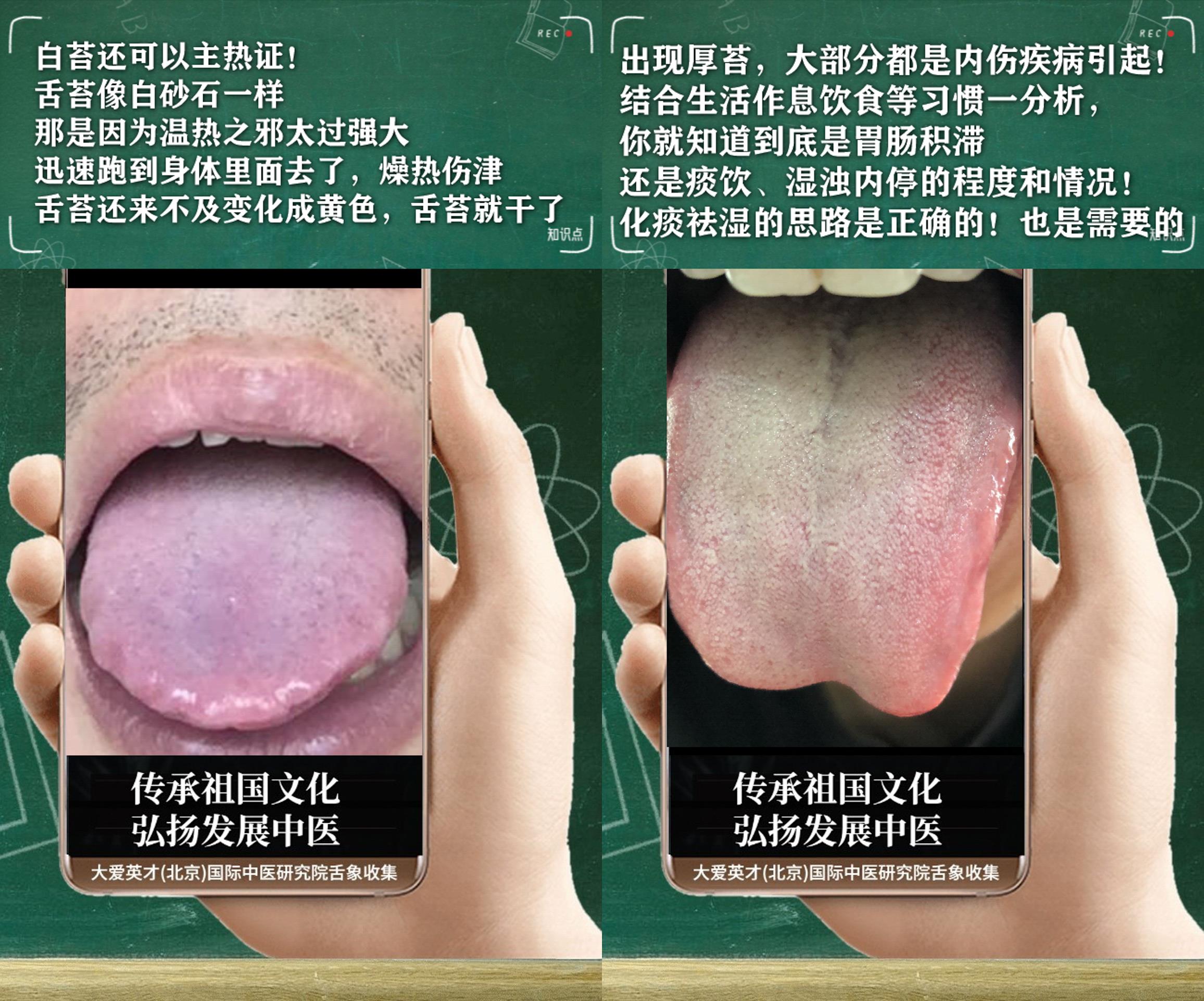 胆固醇|中医医案：易爆躁、无力、胆固醇高、经常反复非常崩溃