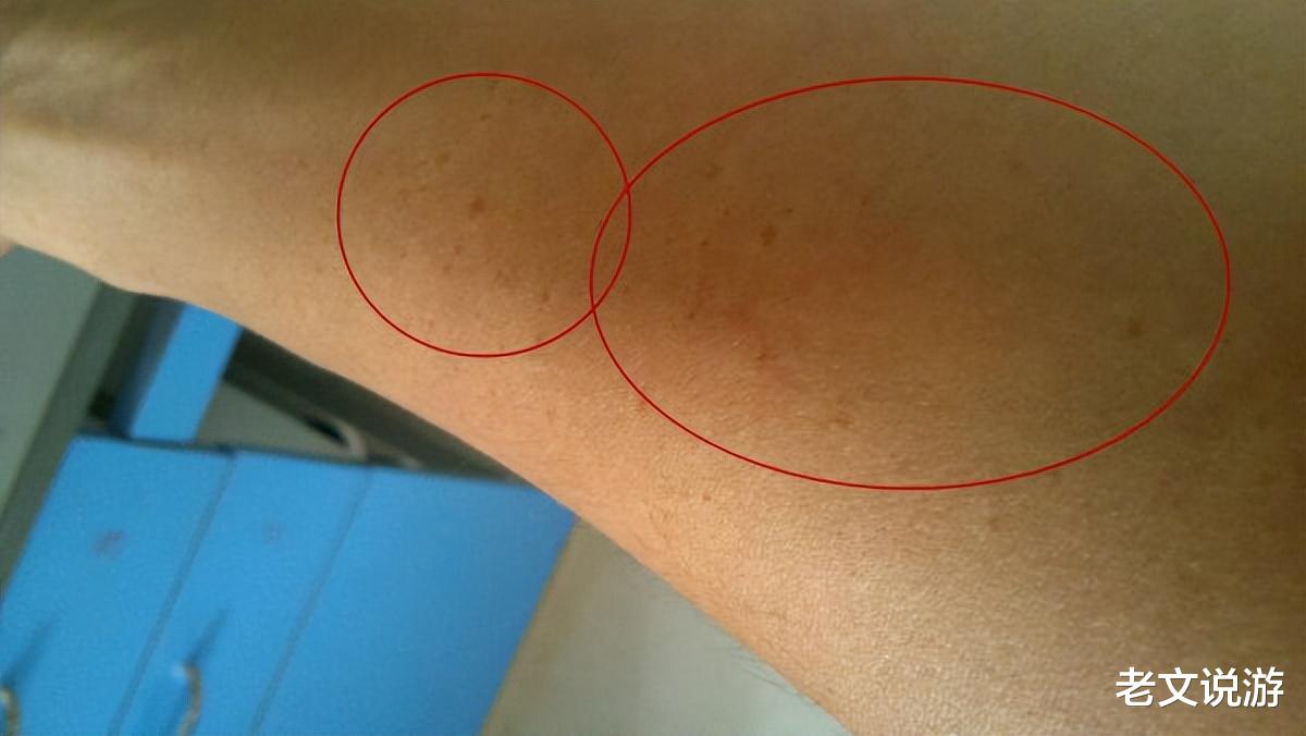 女孩|湖南女孩当试药员，一次9000元不找工作，手臂布满针眼用命赚快钱