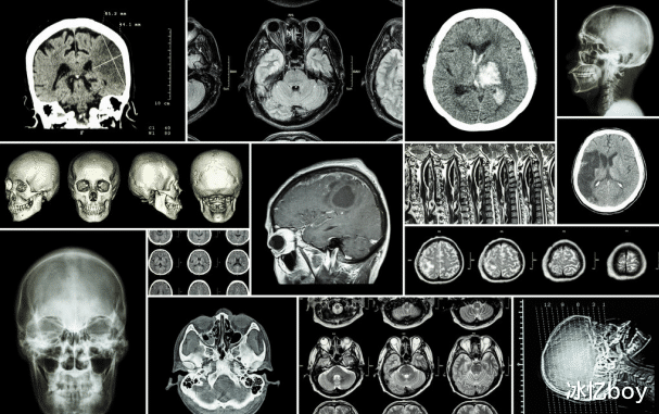高血压|高血压“诱发剂”已找到,吃一次等于5斤盐,不想脑梗缠身,尽快丢