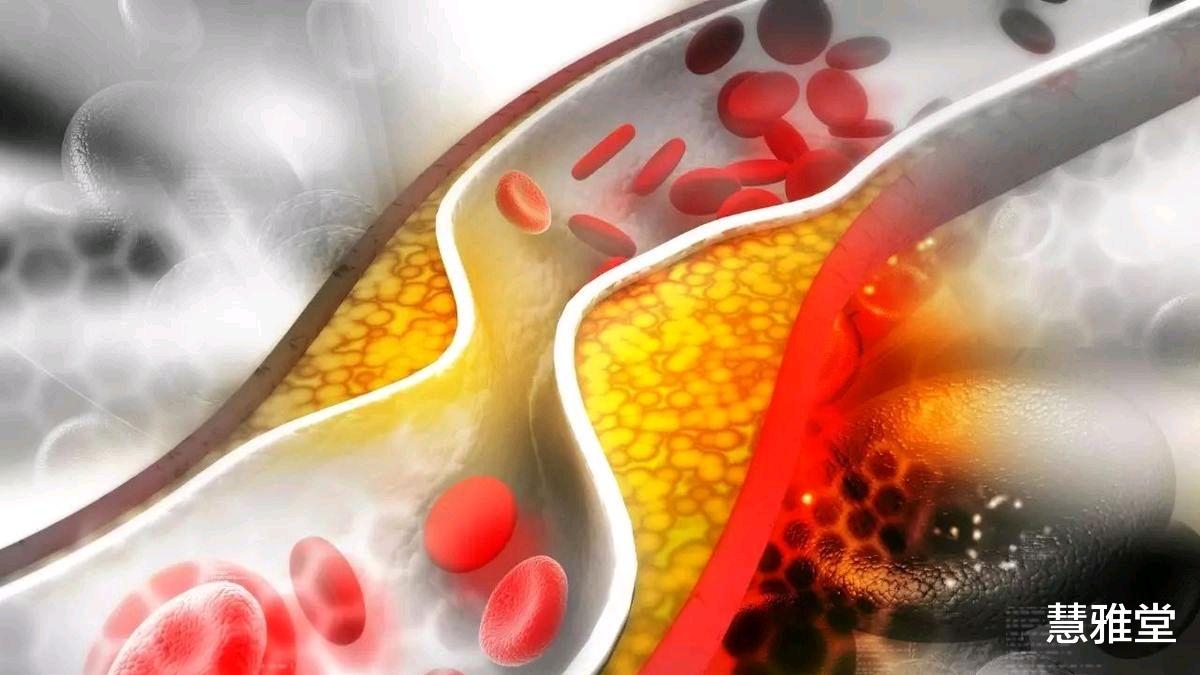 中药|胆固醇升高了，日常有什么方法可以控制？提醒：做好5点有帮助