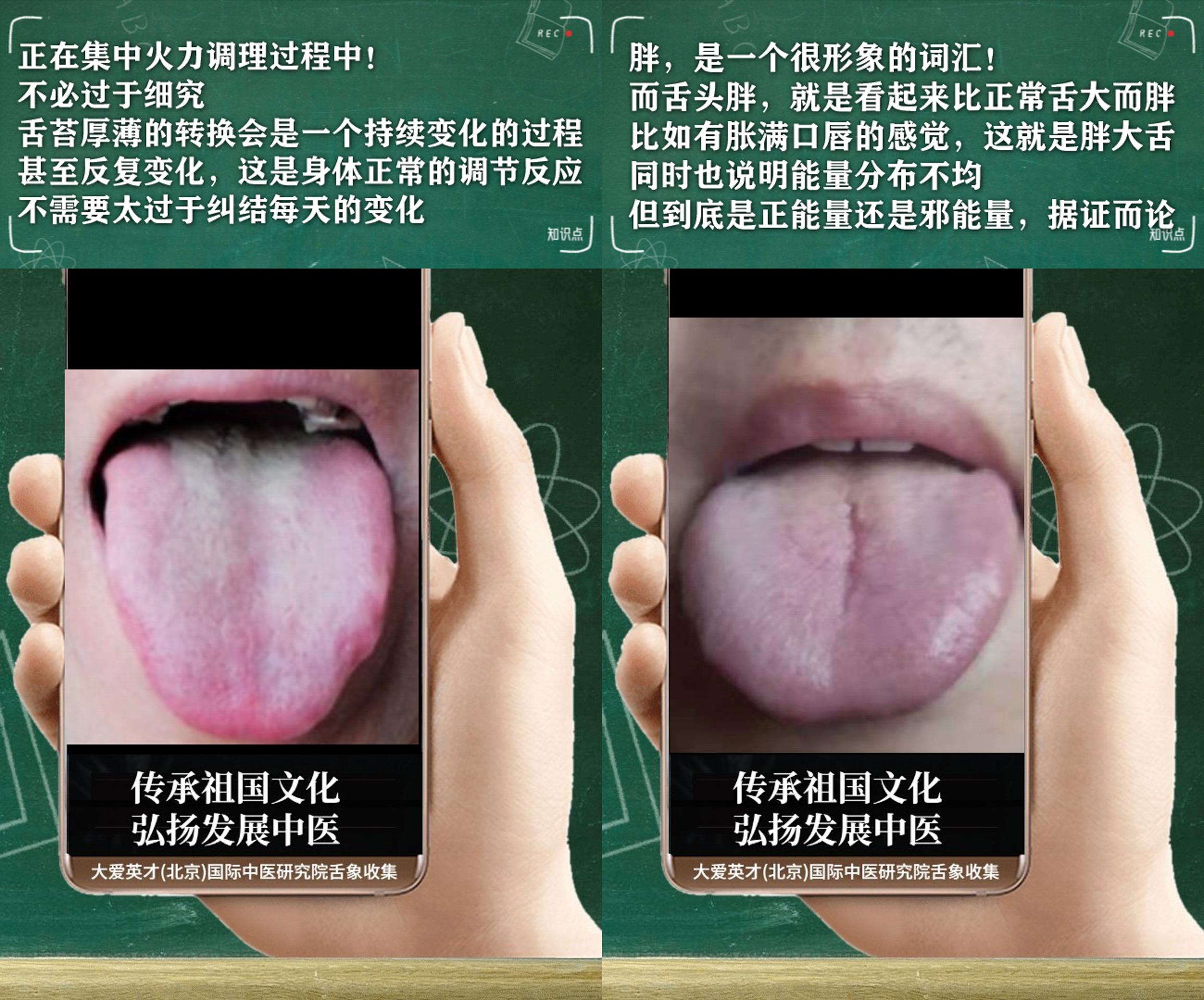 脾胃|中医实例:反复胃痛,爱打喷嚏,多汗且粘,脾胃不和