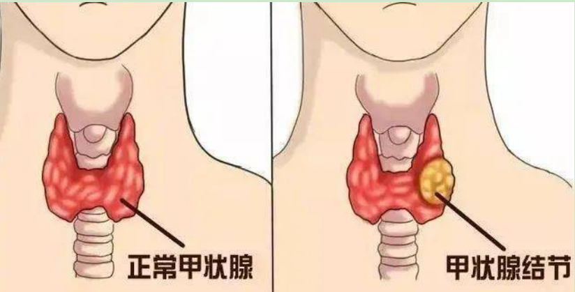 降压药|甲状腺结节为何日益增多?医生:1种菜比碘盐还可怕,趁早戒掉