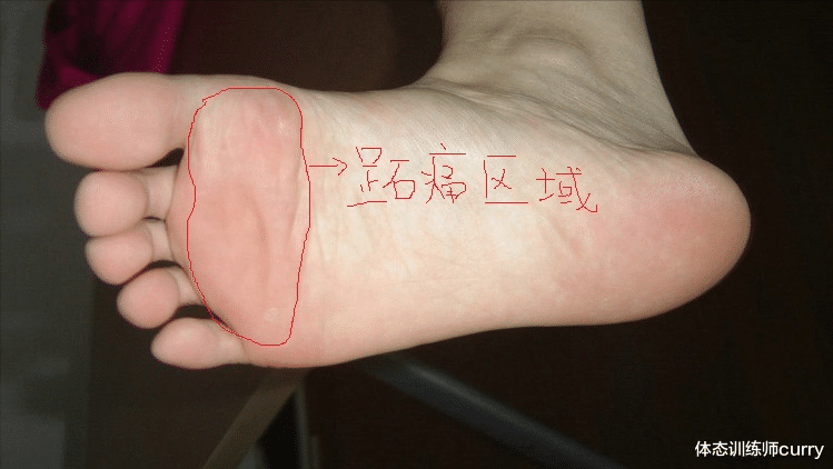中国国际进口博览会|脚底板爱生茧子，走路疼痛是怎么回事？或是这些部位出了问题