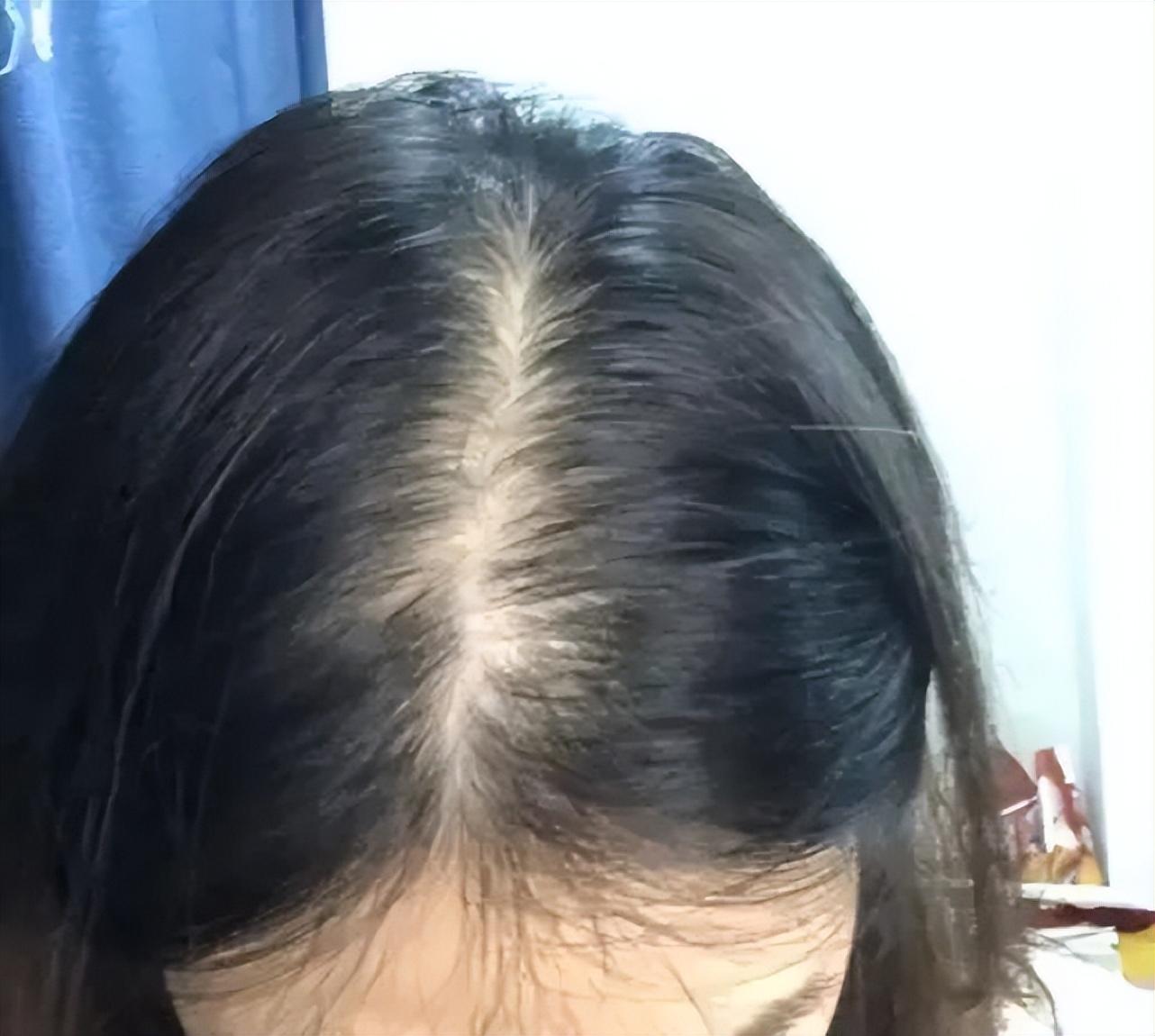 怀孕 几个被严重低估的国货生发液，再少的头发也能拯救！看到就赚到！