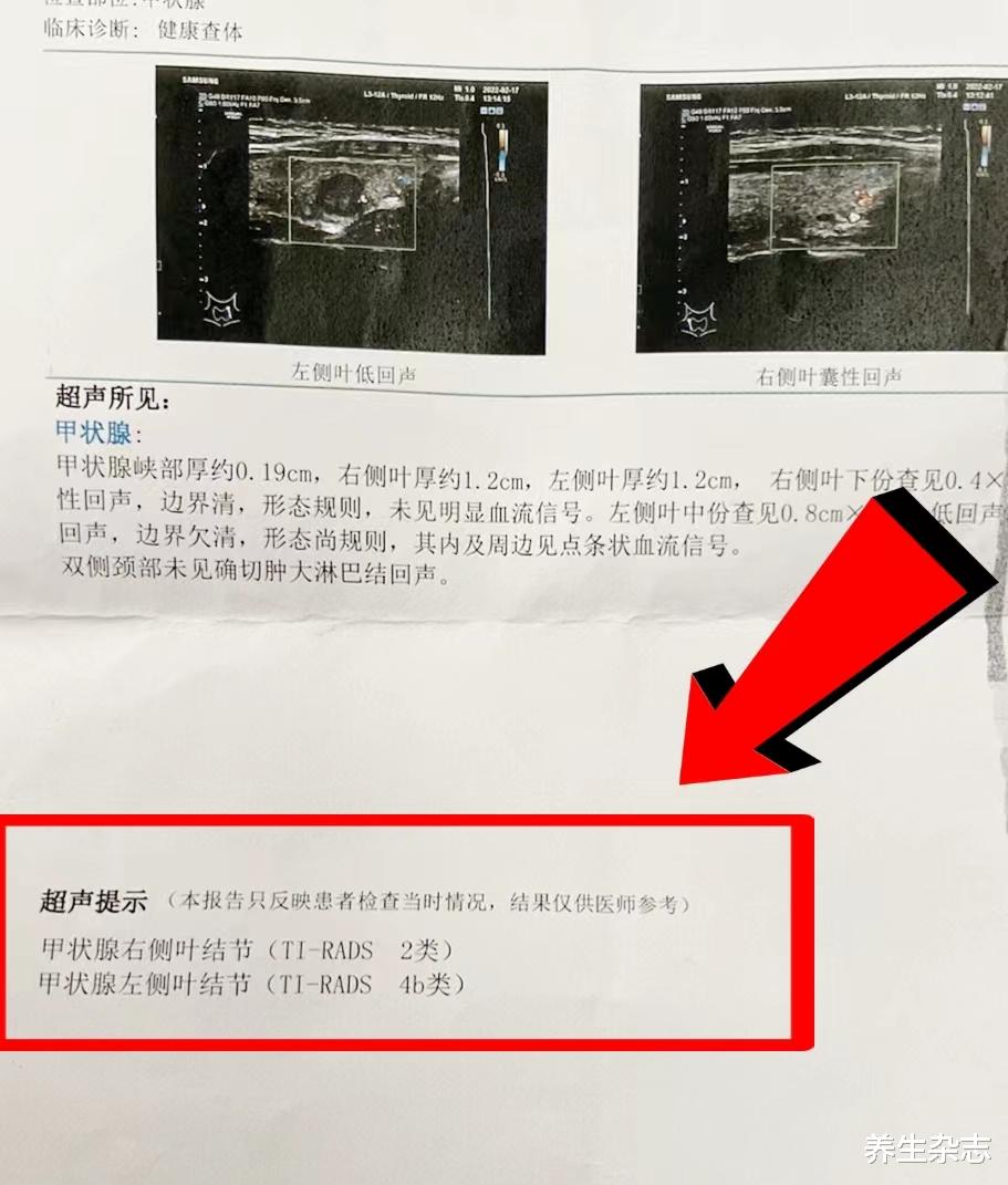 体检|善于“伪装”的肿瘤，初期和咽炎很像，体检若有4个“字样”，引起重视