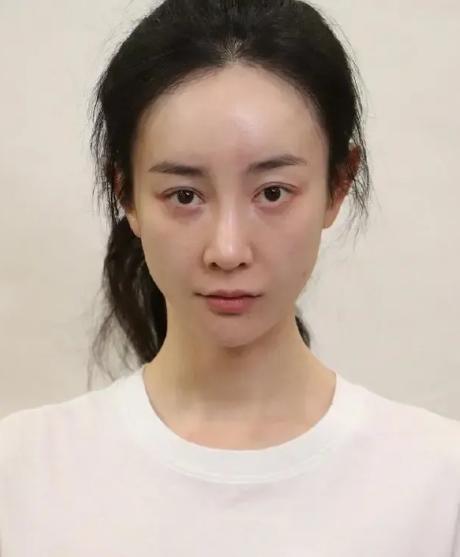 谢依霖|8位女星自曝动脸经历：王鸥打瘦脸针致使面瘫、谢依霖假体歪掉