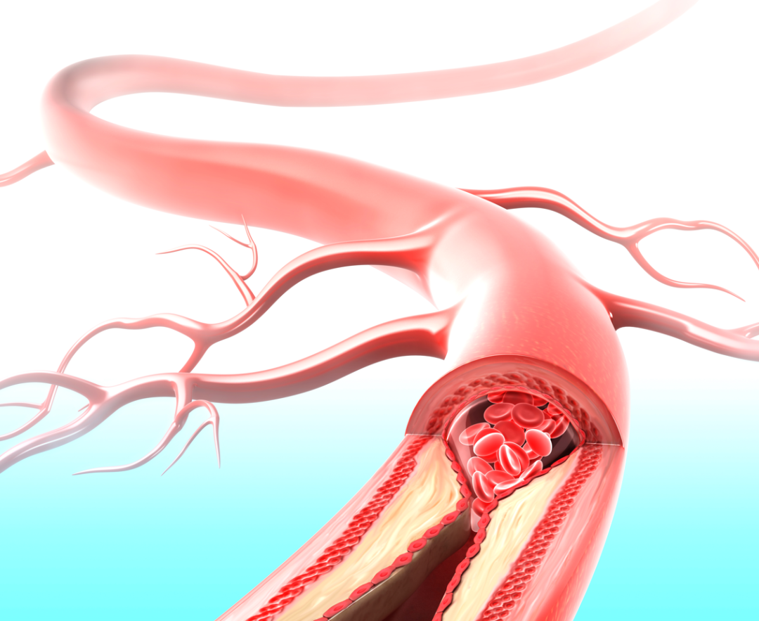 脂肪酸|动脉硬化是“男人最坏的敌人”!牢记5步养护法,疏通血管少堵塞