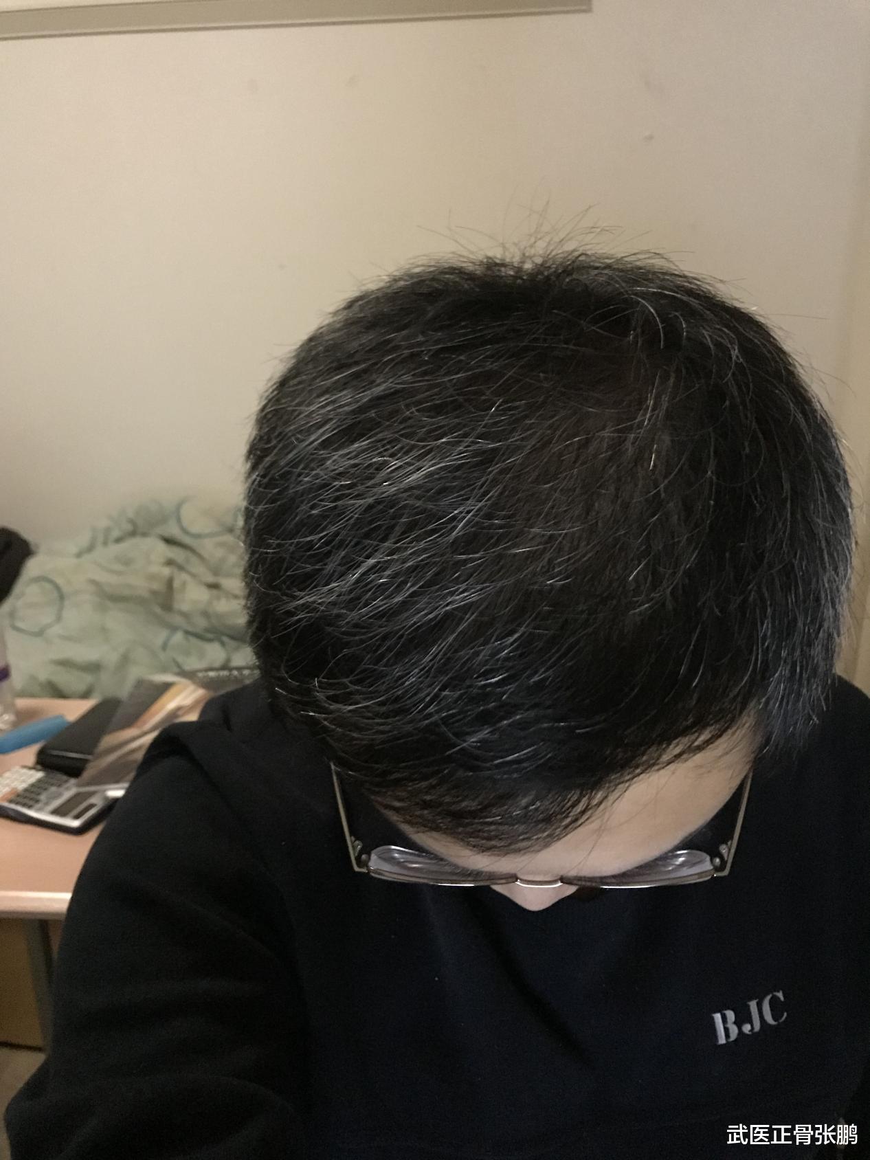 白发|20岁少年长满白发,愁坏家长,老中医给出珍藏1方,轻松长出黑发