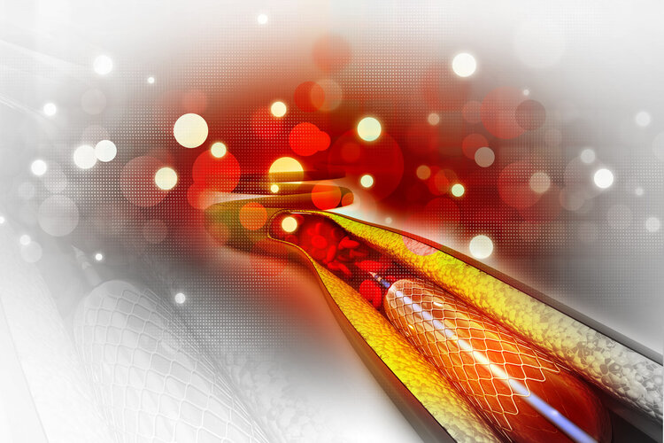 冠状动脉支架|心脏支架:到底是治病救人还是“缺德害人”?装了人就废了吗?