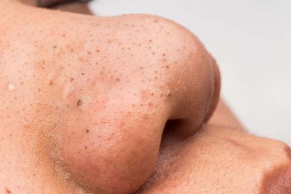 疾病|挤鼻头时出现的白色物质是什么?该如何清理?一文科普分析