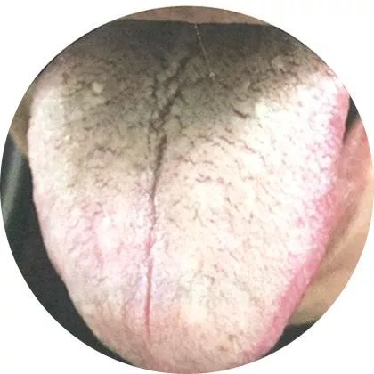 失眠|中医中的舌诊,了解吗