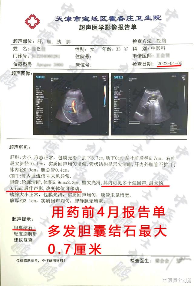 骨质疏松|胆囊炎,胆结石案例