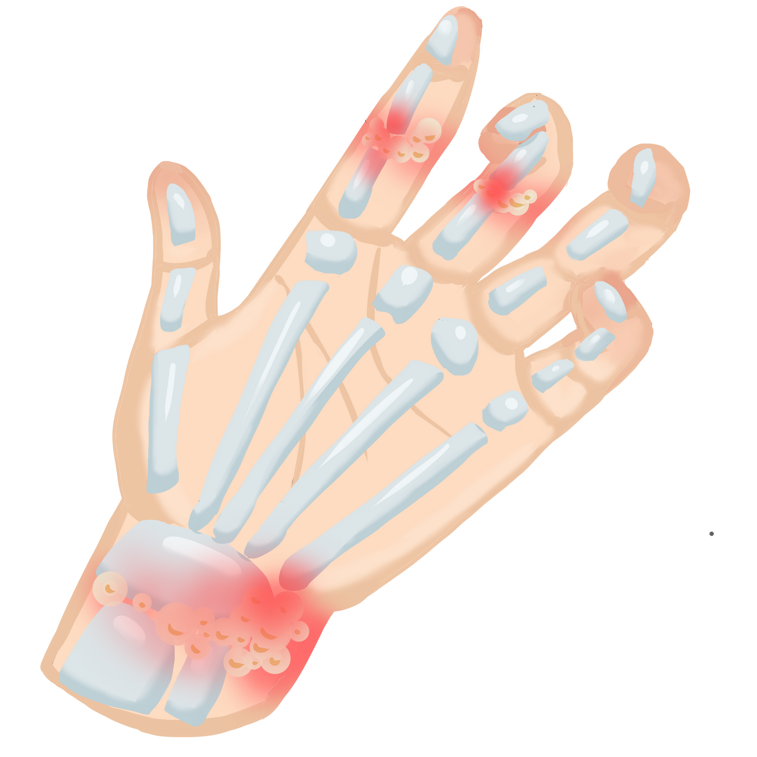 痛风|警惕痛风关节炎,3点自查,尽早发现与治疗!