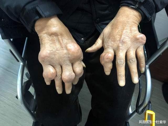 按摩|类风湿患者抹药按摩有作用吗